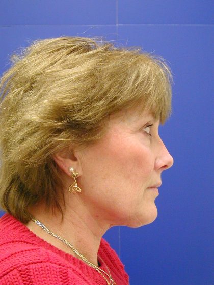 Face/Neck Lift Before & After Patient #549
