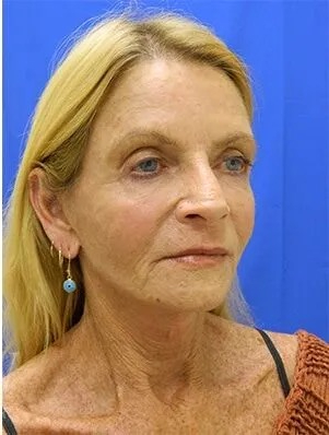 Makeover Before & After Patient #910
