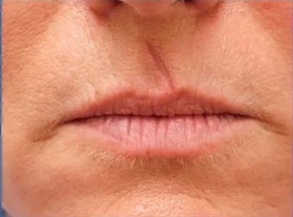 Scar Revision Before & After Patient #1303
