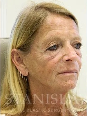 Makeover Before & After Patient #910