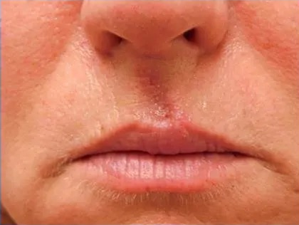 Scar Revision Before & After Patient #1303