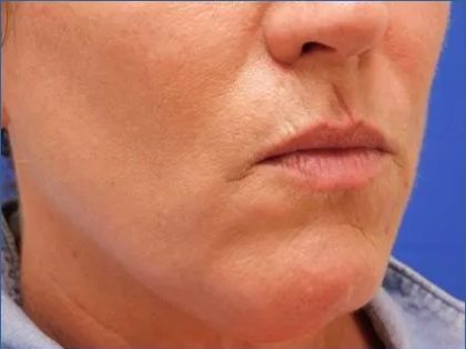 Scar Revision Before & After Patient #1303