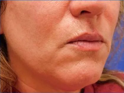 Scar Revision Before & After Patient #1303