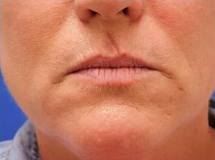 Scar Revision Before & After Patient #1303