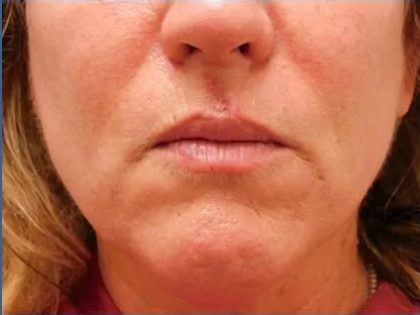Scar Revision Before & After Patient #1303