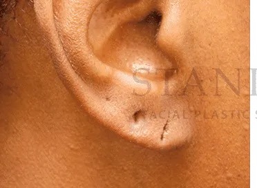 Earlobe Repair Before & After Patient #385