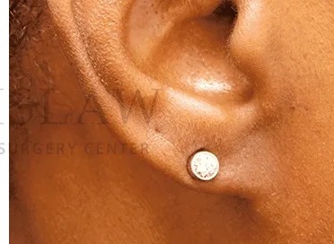 Earlobe Repair Before & After Patient #385