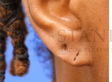 Earlobe Repair Before & After Patient #385