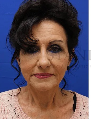 Face/Neck Lift Before & After Patient #531