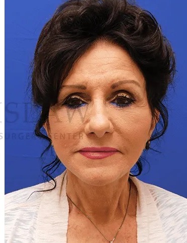 Face/Neck Lift Before & After Patient #531