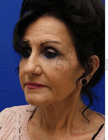 Face/Neck Lift Before & After Patient #531