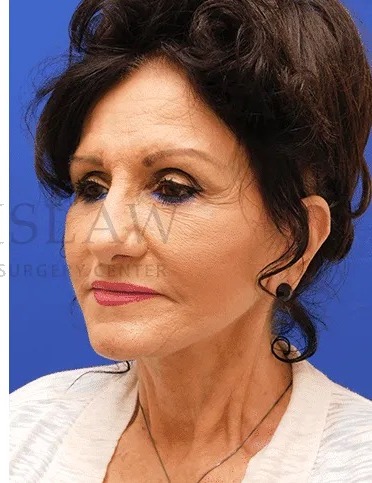 Face/Neck Lift Before & After Patient #531