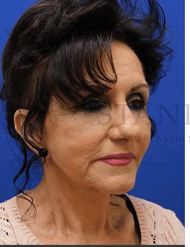 Face/Neck Lift Before & After Patient #531
