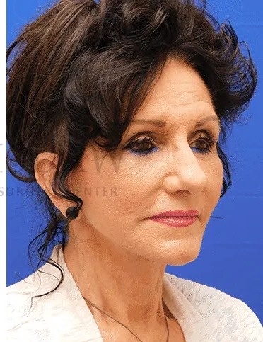 Face/Neck Lift Before & After Patient #531