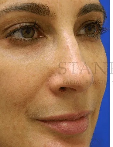 Rhinoplasty Before & After Patient #1170