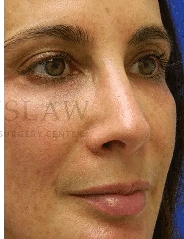 Rhinoplasty Before & After Patient #1170