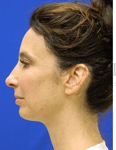 Rhinoplasty Before & After Patient #1170