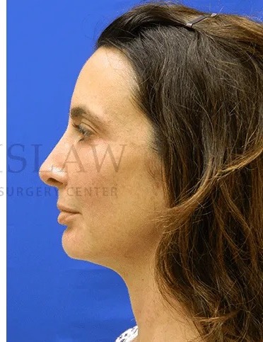 Rhinoplasty Before & After Patient #1170
