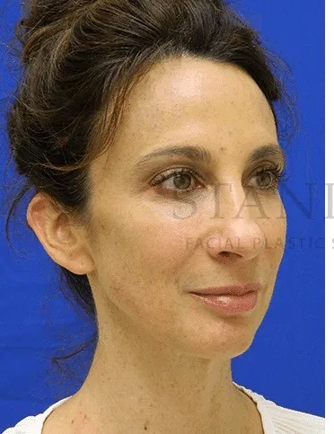 Rhinoplasty Before & After Patient #1170