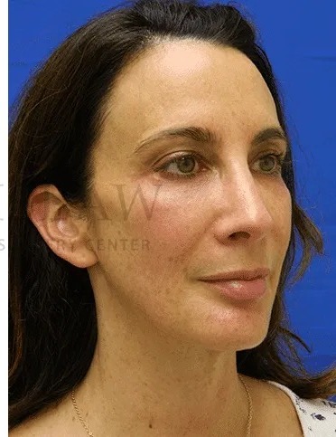 Rhinoplasty Before & After Patient #1170