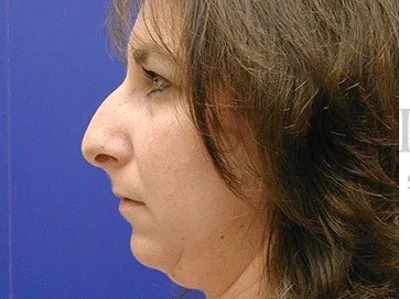 Rhinoplasty Before & After Patient #1163
