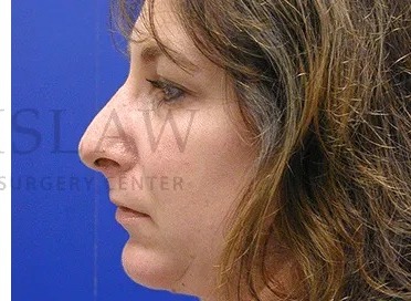 Rhinoplasty Before & After Patient #1163