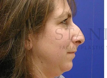 Rhinoplasty Before & After Patient #1163