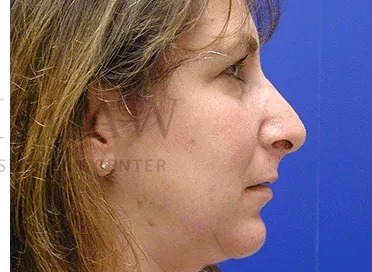 Rhinoplasty Before & After Patient #1163