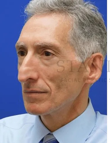 Rhinoplasty Before & After Patient #1158