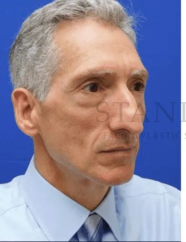 Rhinoplasty Before & After Patient #1158