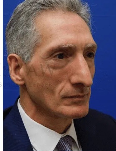 Rhinoplasty Before & After Patient #1158