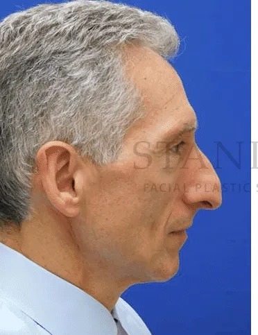 Rhinoplasty Before & After Patient #1158