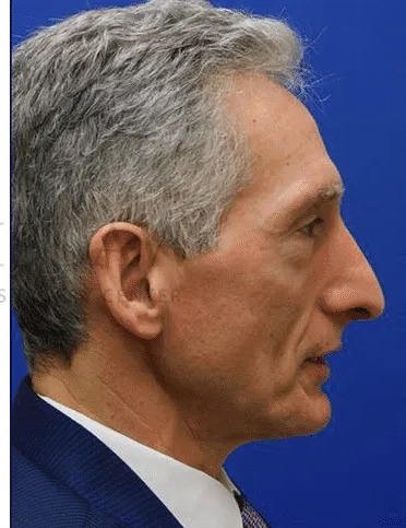 Rhinoplasty Before & After Patient #1158