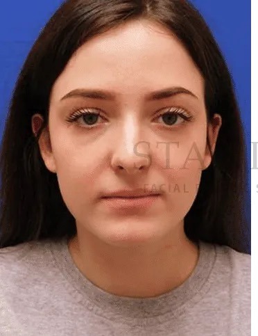 Rhinoplasty Before & After Patient #1149