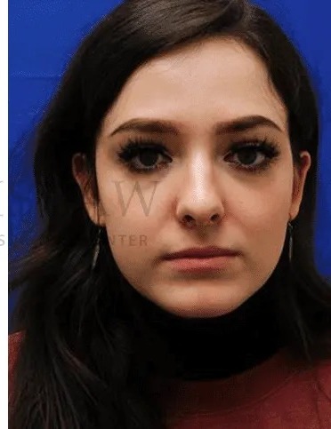 Rhinoplasty Before & After Patient #1149
