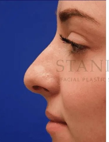 Rhinoplasty Before & After Patient #1149