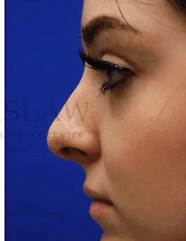 Rhinoplasty Before & After Patient #1149