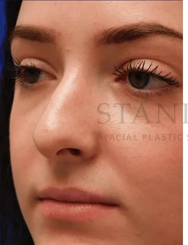 Rhinoplasty Before & After Patient #1149