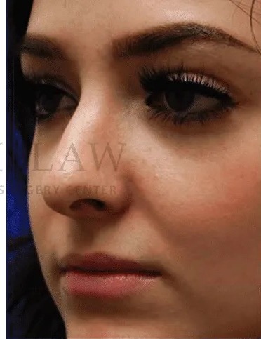 Rhinoplasty Before & After Patient #1149