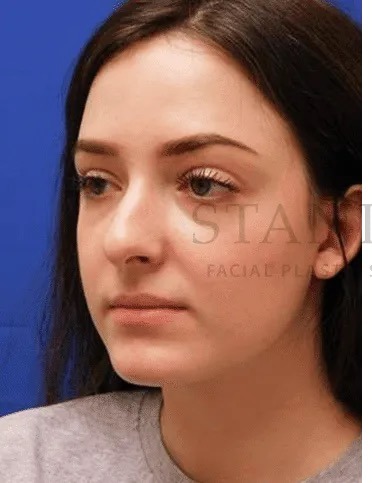 Rhinoplasty Before & After Patient #1149