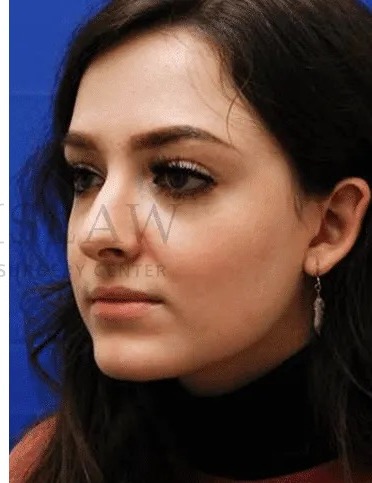 Rhinoplasty Before & After Patient #1149
