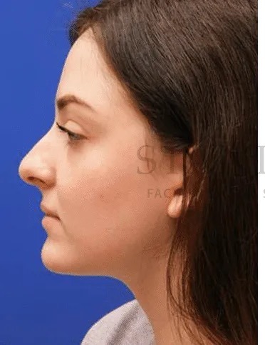 Rhinoplasty Before & After Patient #1149
