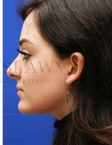 Rhinoplasty Before & After Patient #1149