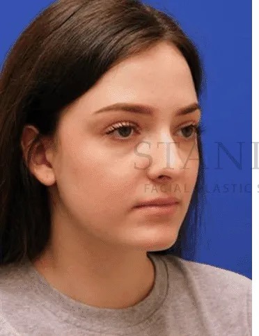 Rhinoplasty Before & After Patient #1149