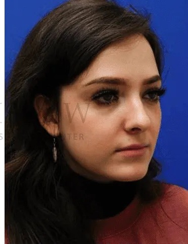 Rhinoplasty Before & After Patient #1149
