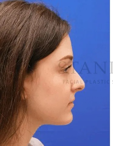 Rhinoplasty Before & After Patient #1149