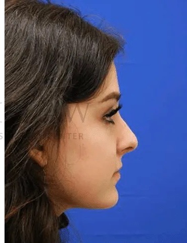 Rhinoplasty Before & After Patient #1149