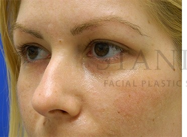 Tear Trough Filler Before & After Patient #1477