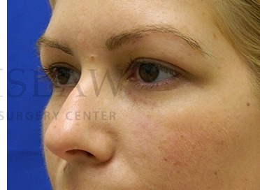 Tear Trough Filler Before & After Patient #1477