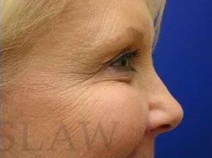 Botox Dysport Before & After Patient #156